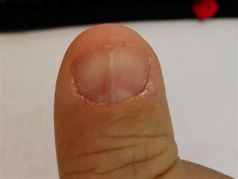 弧形門片 指甲裂痕缺什麼